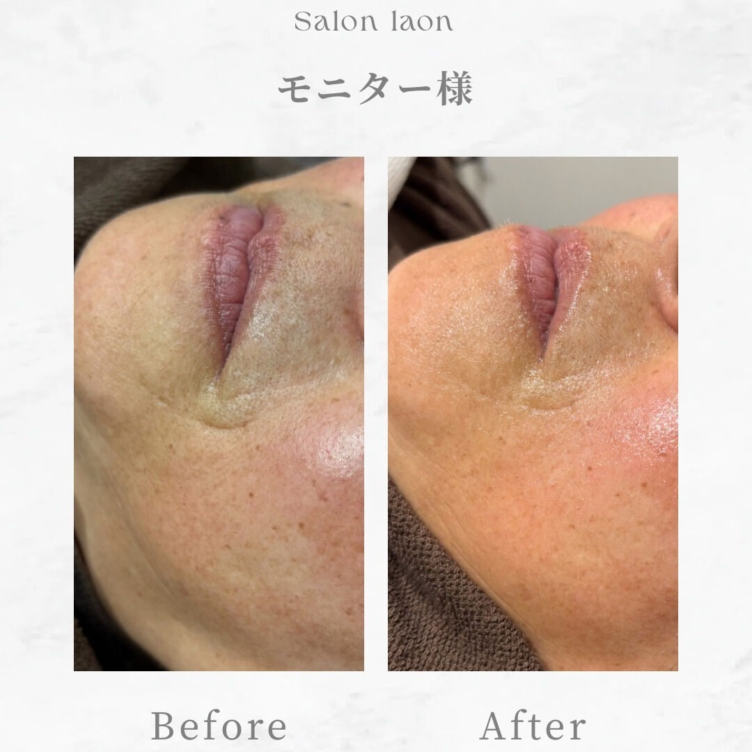 こんにちは！私たちのサロンでは、最新技術の刺さない美容鍼を提