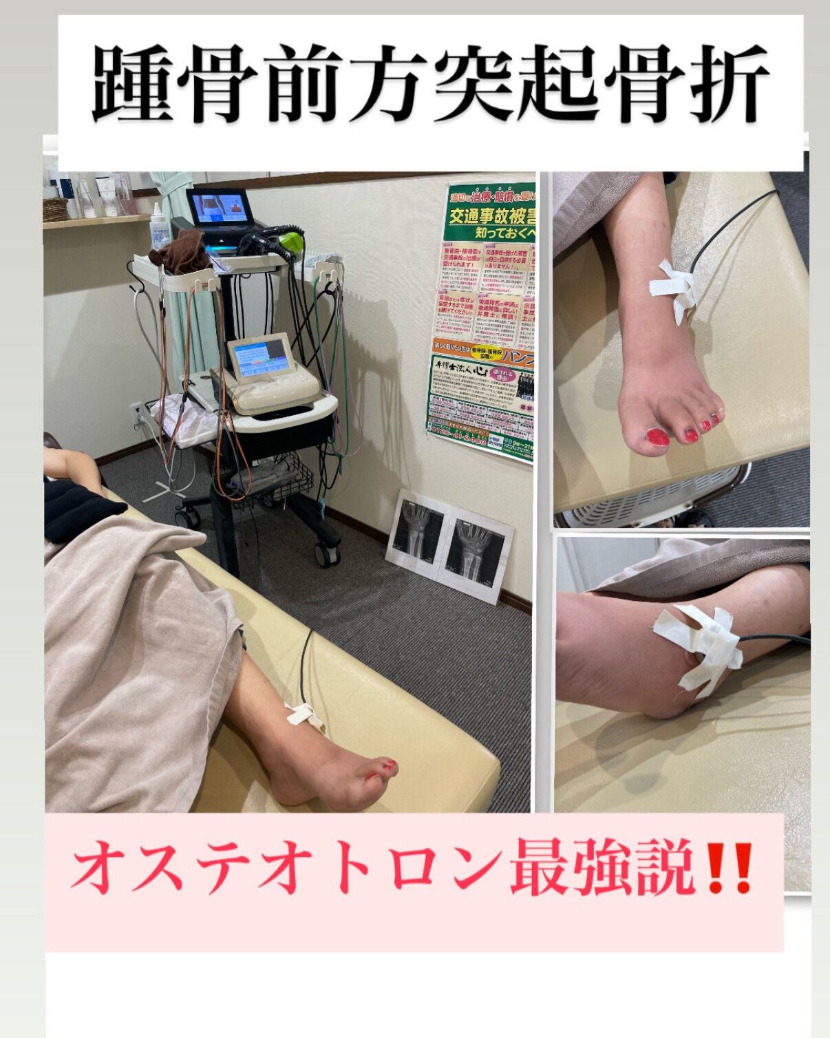 踵骨前方突起骨折の治療
